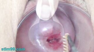 Extreme Cervix Playing With Insertion Metal Chain In Uterus